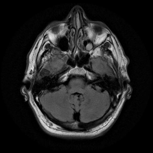 File:Aqueduct stenosis with corpus callosum hypoattenuation post shunting (Radiopaedia 37212-38969 Axial FLAIR 5).png