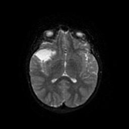 Arachnoid cyst - middle cranial fossa (Radiopaedia 67671-77088 Axial DWI 41).jpg