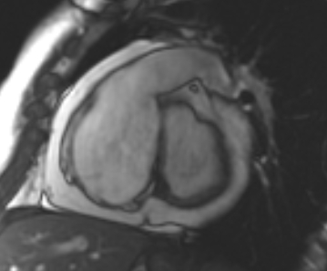 File:Arrhythmogenic right ventricular cardiomyopathy (Radiopaedia 69431-79307 Short axis cine 200).jpg