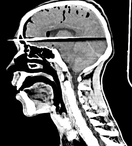 Arrow injury to the brain (Radiopaedia 72101-82607 H 36).jpg
