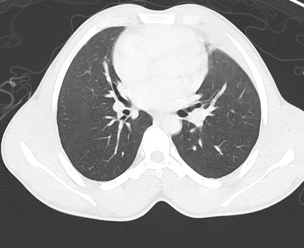 Arrow injury to the chest (Radiopaedia 75223-86321 Axial lung window 39).jpg