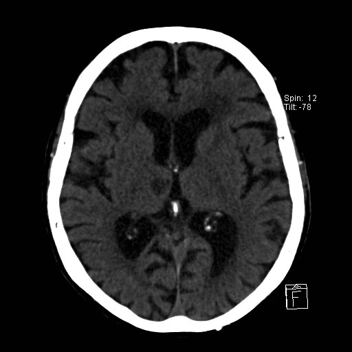 File:Artery of Percheron infarction (Radiopaedia 26307-26439 Axial non-contrast 21).jpg