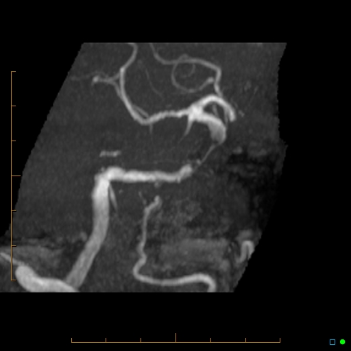 File:Artifactual basilar artery stenosis due to metallic stent (Radiopaedia 31206-31922 3D MIP 6).jpg