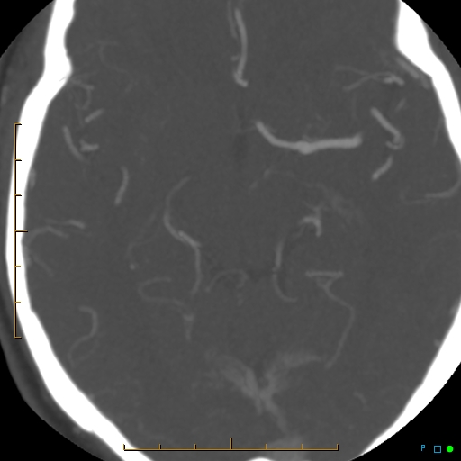 File:Artifactual basilar artery stenosis due to metallic stent (Radiopaedia 31206-31923 A 20).jpg