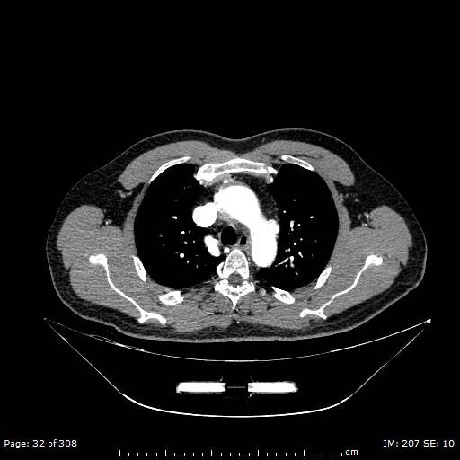 File:Ascending aortic aneurysm (Radiopaedia 50086-55404 A 10).jpg