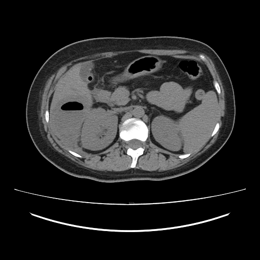 Ascending retrocecal appendicitis with liver abscesses (Radiopaedia 60066-67615 Axial non-contrast 30).jpg