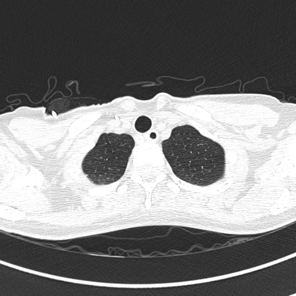 Aspergilloma (Radiopaedia 26223-26347 Axial lung window 7).jpg