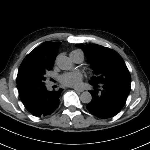 Aspergilloma on background pulmonary fibrosis (Radiopaedia 60942-68757 Axial non-contrast 32).jpg