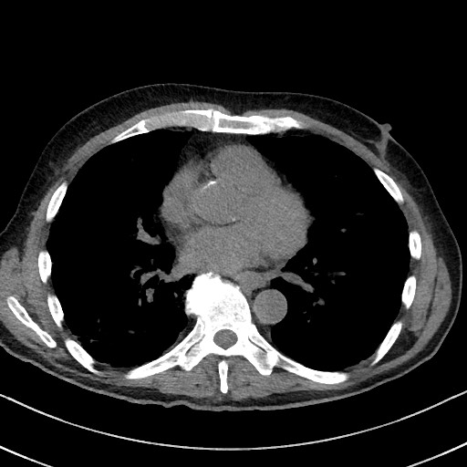 Aspergilloma on background pulmonary fibrosis (Radiopaedia 60942-68757 Axial non-contrast 35).jpg