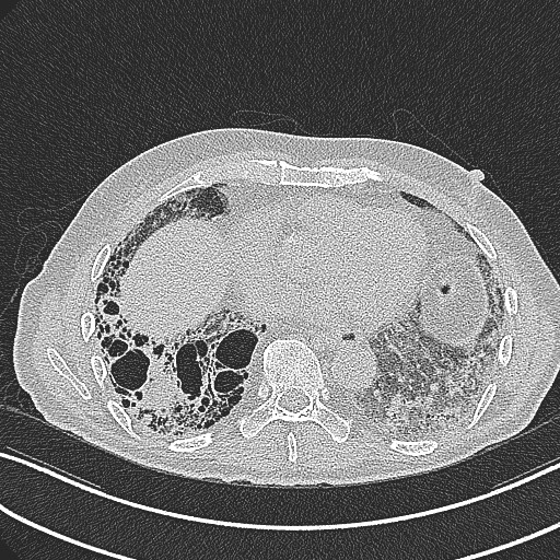 File:Aspergilloma on background pulmonary fibrosis (Radiopaedia 60942-68757 B 35).jpg