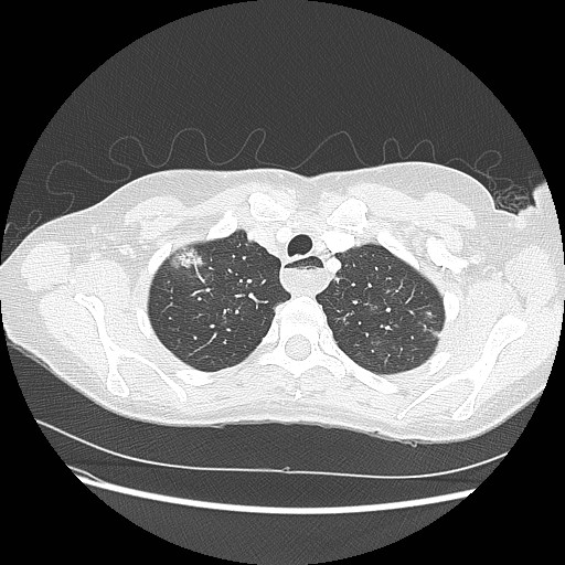 Aspiration pneumonia secondary to laparoscopic banding (Radiopaedia 18345-18183 lung window 16).jpg