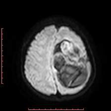 File:Astroblastoma (Radiopaedia 74287-85162 Axial DWI 85).jpg