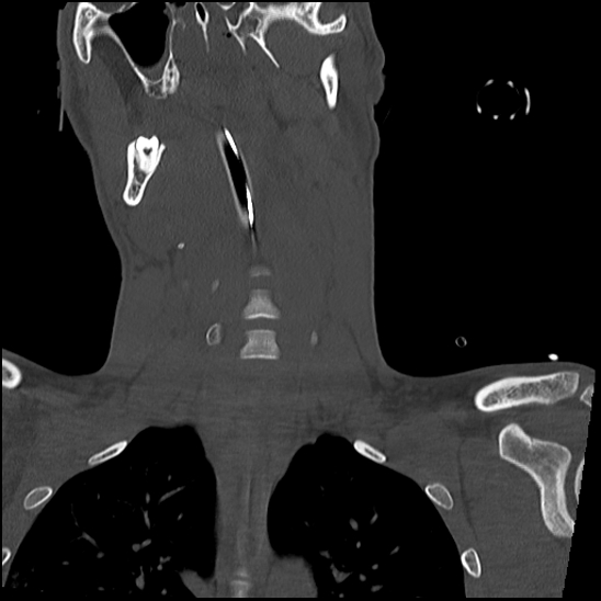 Atlanto-occipital dissociation (Traynelis type 1), C2 teardrop fracture, C6-7 facet joint dislocation (Radiopaedia 87655-104061 Coronal bone window 30).jpg