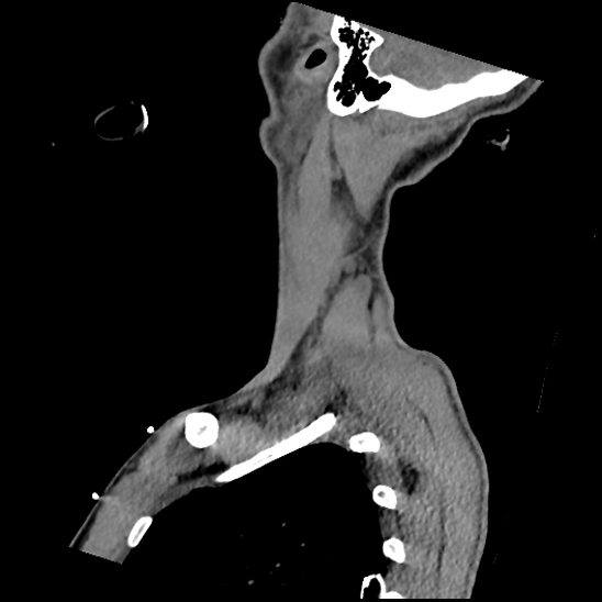 Atlanto-occipital dissociation (Traynelis type 1), C2 teardrop fracture, C6-7 facet joint dislocation (Radiopaedia 87655-104061 D 73).jpg