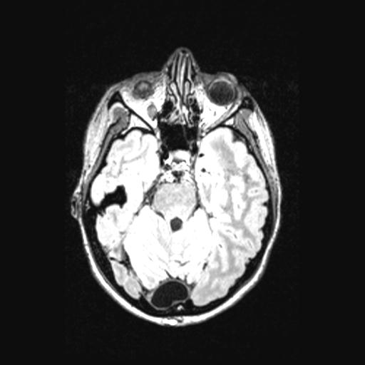 Atretic encephalocoele with inferior vermis hypoplasia (Radiopaedia 30443-31108 Axial 56).jpg