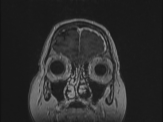 Atypical meningioma (Radiopaedia 62985-71406 Coronal T1 C+ 11).jpg