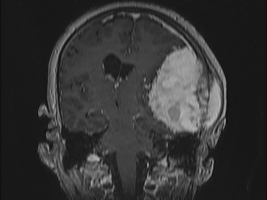 Atypical meningioma (Radiopaedia 62985-71406 Coronal T1 C+ 69).jpg