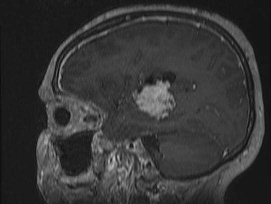 Atypical meningioma (Radiopaedia 62985-71406 Sagittal T1 C+ 63).jpg