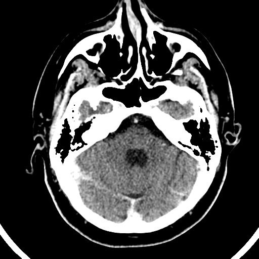 Atypical meningioma (WHO grade II) with brain invasion (Radiopaedia 57767-64728 Axial C+ 42).png