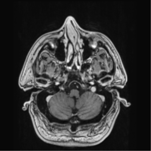 File:Atypical meningioma (WHO grade II) with brain invasion (Radiopaedia 57767-64729 Axial T1 C+ 7).png