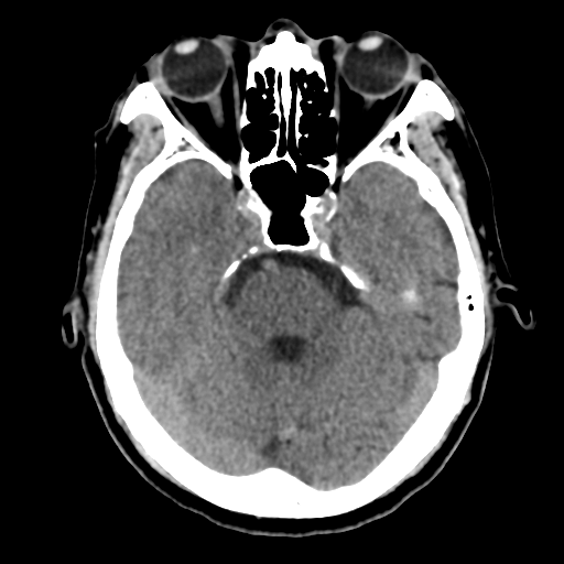 Atypical meningioma (WHO grade II) with osseous invasion (Radiopaedia 53654-59715 Axial non-contrast 18).png