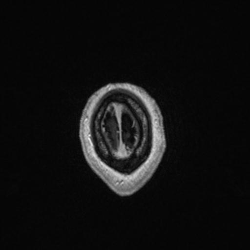 Atypical meningioma (grade II) - en plaque (Radiopaedia 29633-30147 Axial T1 C+ 169).jpg