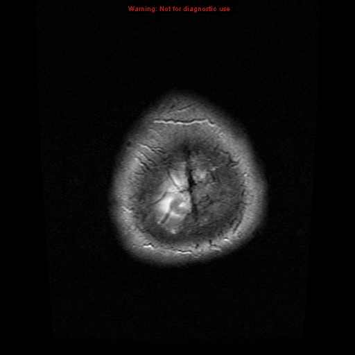File:Atypical meningioma - grade II (Radiopaedia 13303-13305 Axial T2 22).jpg