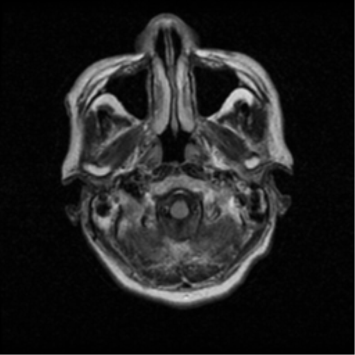 File:Atypical meningioma with skull invasion (Radiopaedia 34357-35648 Axial FLAIR 2).png