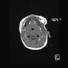 Atypical teratoid rhabdoid tumor (prenatal US and neonatal MRI) (Radiopaedia 59091-66388 Axial T1 5).jpg