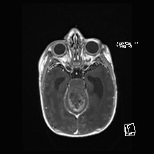 File:Atypical teratoid rhabdoid tumor (prenatal US and neonatal MRI) (Radiopaedia 59091-66388 Axial T1 C+ 23).jpg