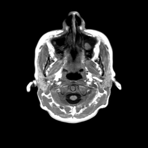 Autoimmune limbic encephalitis (Radiopaedia 30363-31005 T1 Axial 3mm 1).jpg