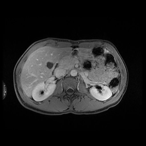 Autoimmune pancreatitis (Radiopaedia 69751-79729 N 67).jpg