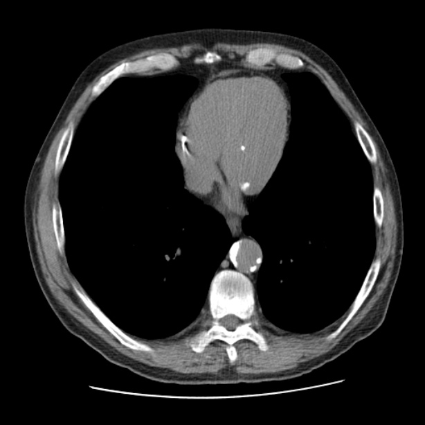 Autosomal dominant polycystic kidney disease (Radiopaedia 27851-28094 Axial non-contrast 40).jpg