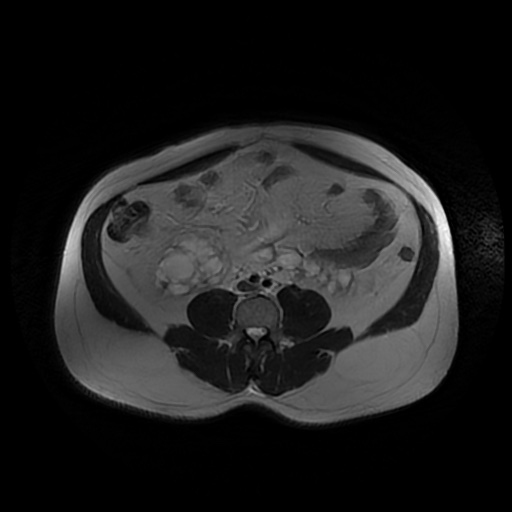 File:Autosomal dominant polycystic kidney disease (Radiopaedia 50259-55611 Axial T2 33).jpg