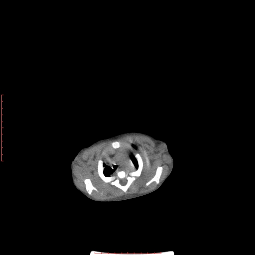 Autosomal recessive polycystic kidney disease associated with Caroli disease (Radiopaedia 61932-69984 Axial non-contrast 17).jpg