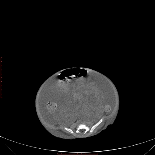 File:Autosomal recessive polycystic kidney disease associated with Caroli disease (Radiopaedia 61932-69984 B 270).jpg