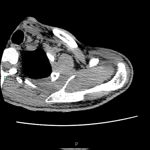 File:Avascular necrosis after fracture dislocations of the proximal humerus (Radiopaedia 88078-104653 D 21).jpg