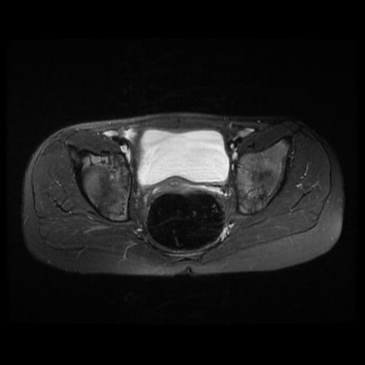 File:Avascular necrosis of the hip (Radiopaedia 29563-30067 Axial T2 fat sat 3).jpg