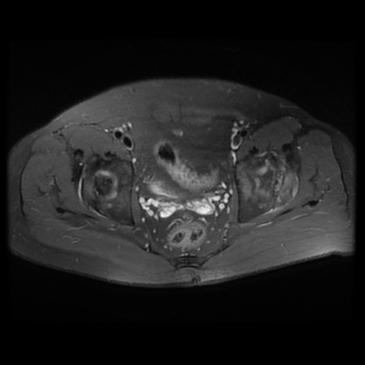 File:Avascular necrosis of the hip (Radiopaedia 61503-69465 Axial PD fat sat 14).jpg