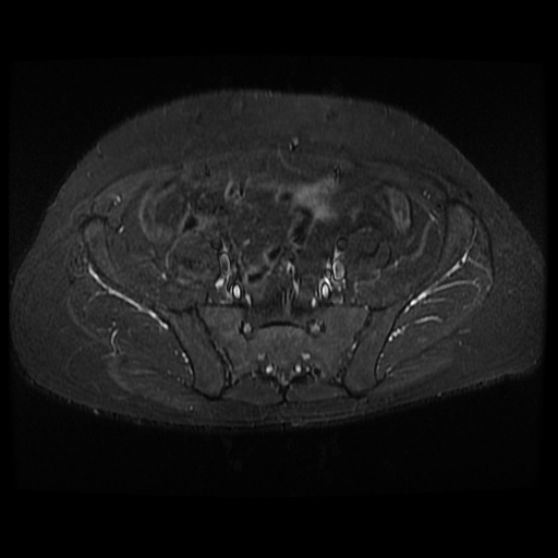 File:Avascular necrosis of the hip (Radiopaedia 61503-69465 Axial STIR 3).jpg
