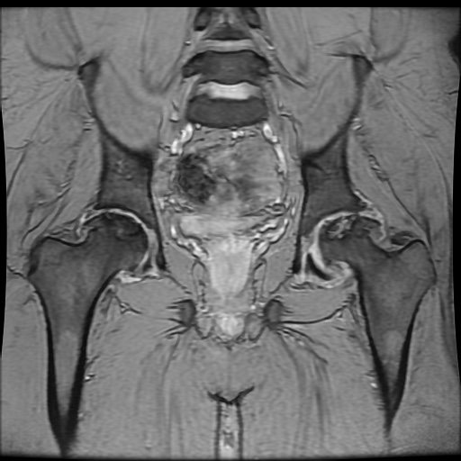 Avascular necrosis of the hip (Radiopaedia 61503-69465 F 55).jpg