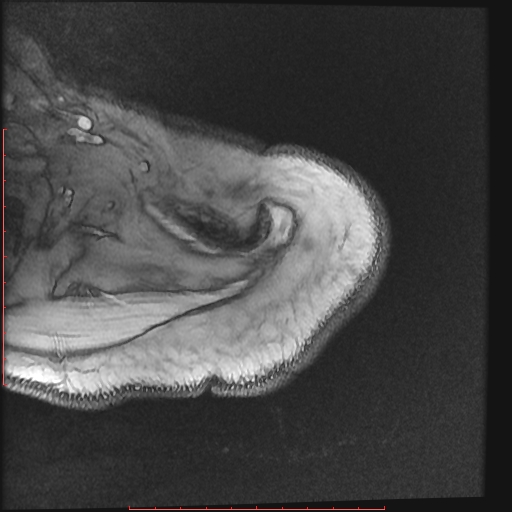 File:Avulsion fracture - greater tuberosity of humerus (Radiopaedia 25457-25703 Axial Gradient Echo 1).jpg