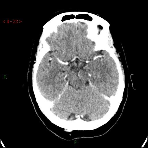 Azygos anterior cerebral artery (Radiopaedia 51987-57833 A 23).jpg