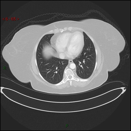 Azygos fissure and lobe (Radiopaedia 47620-52278 Axial lung window 65).jpg
