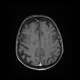 Balo concentric sclerosis (Radiopaedia 53875-59982 Axial LAVA C+ 185).jpg