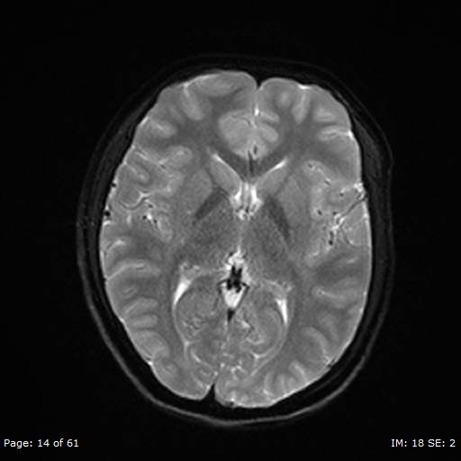 Balo concentric sclerosis (Radiopaedia 61637-69636 Axial DWI 14).jpg