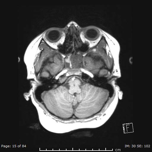 Balo concentric sclerosis (Radiopaedia 61637-69636 Axial T1 15).jpg