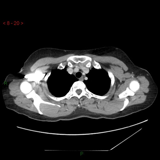 Bartholin gland cyst (Radiopaedia 54904-61181 A 5).jpg