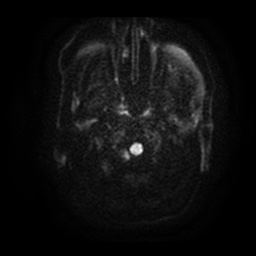File:Basal cell carcinoma (periorbital) (Radiopaedia 55179-61559 Axial DWI 2).jpg