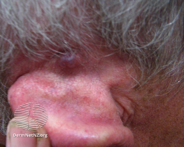File:Basal cell carcinoma affecting the ear (DermNet NZ lesions-bcc-ear-0667).jpg